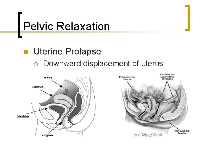 Pelvic Relaxation n Uterine Prolapse ¡ Downward displacement of uterus 