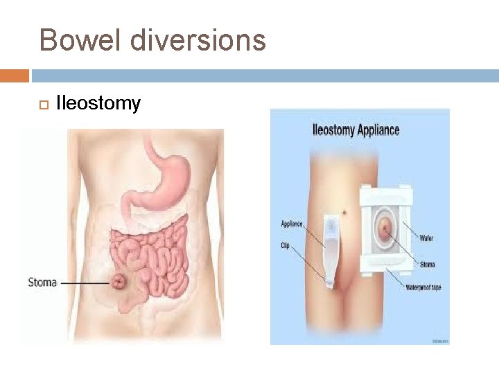 Bowel diversions Ileostomy 