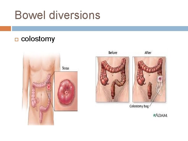 Bowel diversions colostomy 