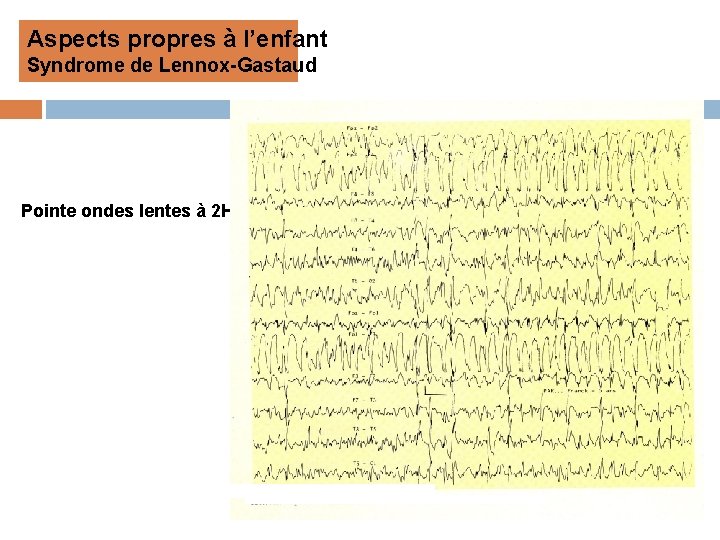 Aspects propres à l’enfant Syndrome de Lennox-Gastaud Pointe ondes lentes à 2 Hz 