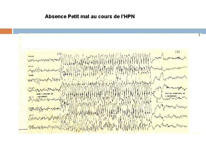 Absence Petit mal au cours de l’HPN 