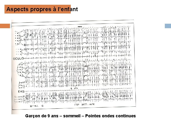 Aspects propres à l’enfant Garçon de 9 ans – sommeil – Pointes ondes continues