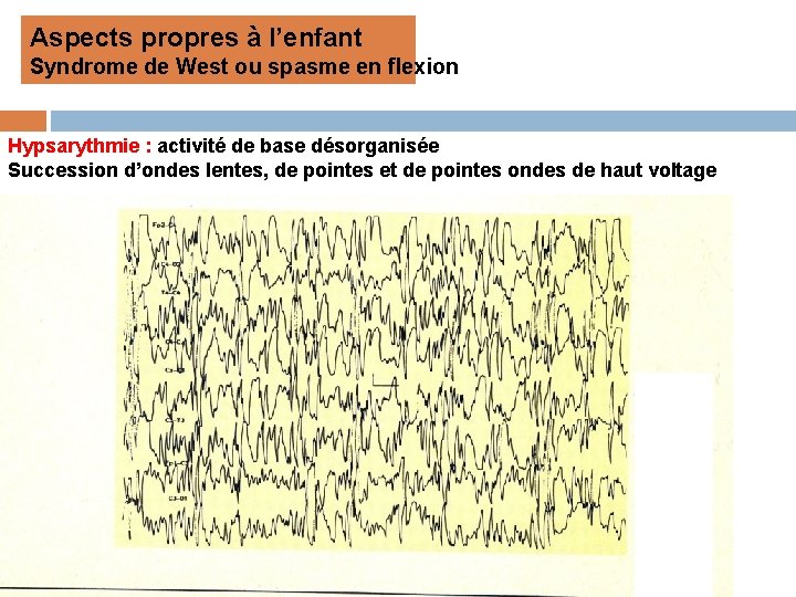 Aspects propres à l’enfant Syndrome de West ou spasme en flexion Hypsarythmie : activité