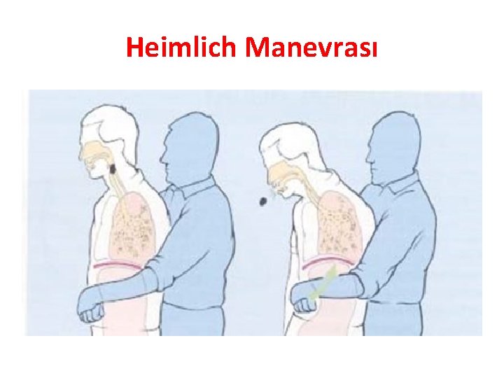 Heimlich Manevrası 