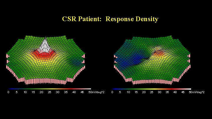 CSR Patient: Response Density 0 5 10 15 20 25 30 35 40 45
