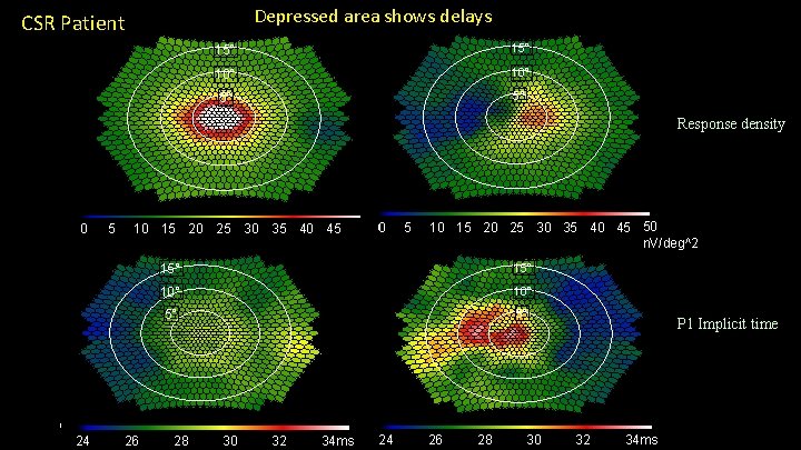 Depressed area shows delays CSR Patient 15° 10° 5° 5° Response density 0 24