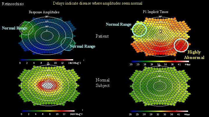 Delays indicate disease where amplitudes seem normal Retinoschisis P 1 Implicit Times Response Amplitudes