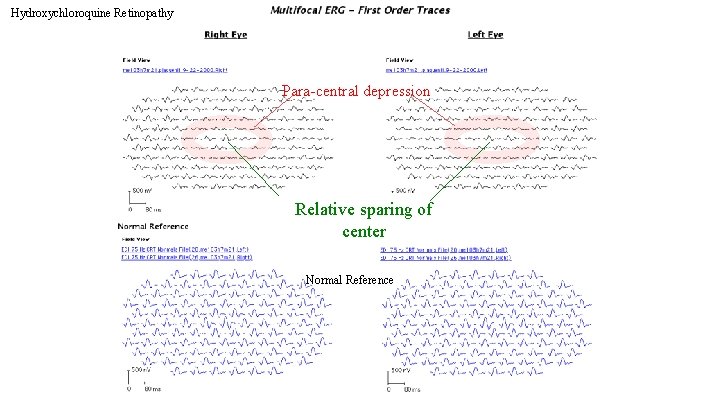 Hydroxychloroquine Retinopathy Para-central depression Relative sparing of center Normal Reference 