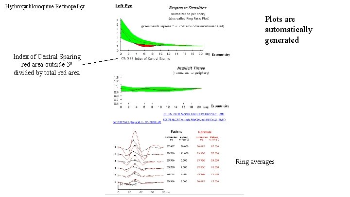 Hydroxychloroquine Retinopathy Plots are automatically generated Index of Central Sparing red area outside 30