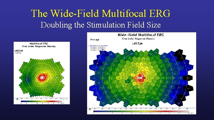 The Wide-Field Multifocal ERG Doubling the Stimulation Field Size 