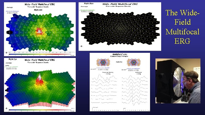 The Wide. Field Multifocal ERG 