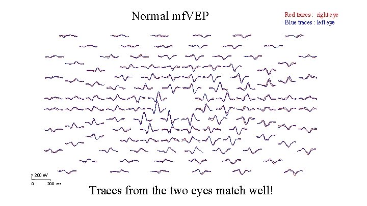 Normal mf. VEP 200 n. V 0 200 ms Traces from the two eyes