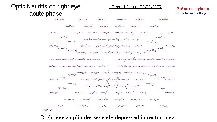 Optic Neuritis on right eye acute phase Record Dated: 03 -26 -2007 Right eye