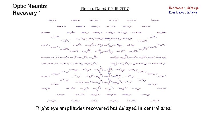 Optic Neuritis Recovery 1 Record Dated: 05 -19 -2007 Red traces : right eye