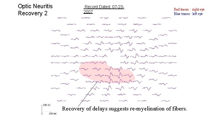 Optic Neuritis Recovery 2 Record Dated: 07 -232007 Red traces : right eye Blue