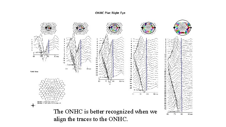 The ONHC is better recognized when we align the traces to the ONHC. 