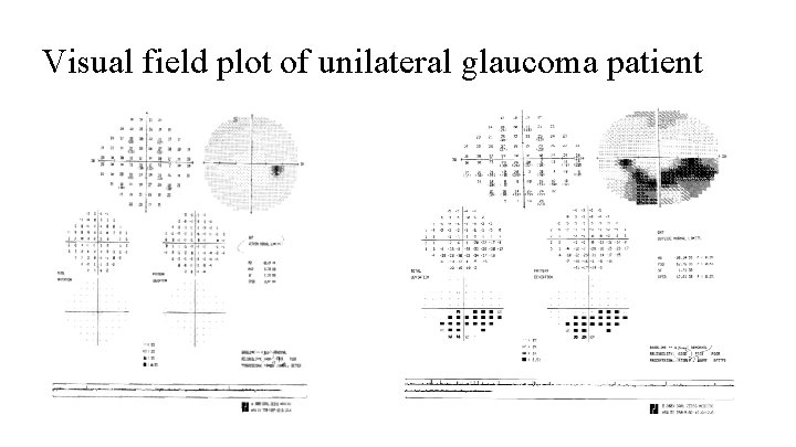 Visual field plot of unilateral glaucoma patient 