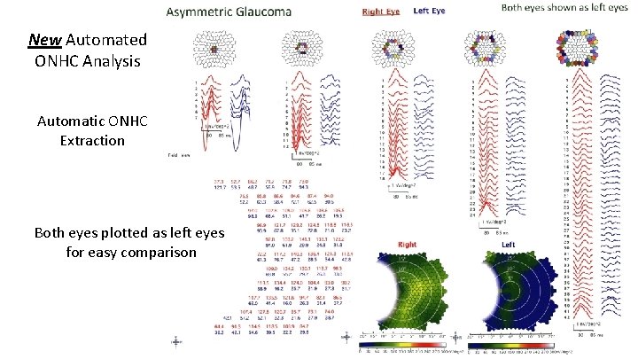 New Automated ONHC Analysis Automatic ONHC Extraction Both eyes plotted as left eyes for
