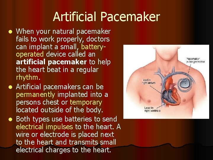 Artificial Pacemaker When your natural pacemaker fails to work properly, doctors can implant a