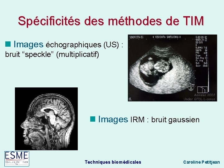 Spécificités des méthodes de TIM Images échographiques (US) : bruit “speckle” (multiplicatif) Images IRM