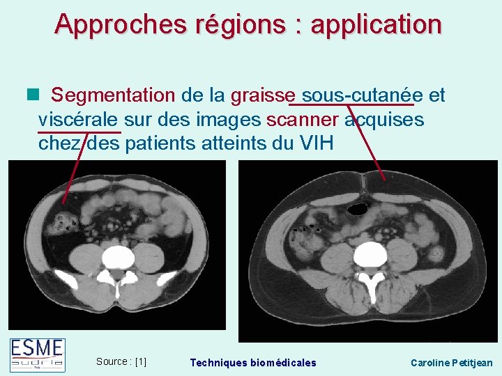 Approches régions : application Segmentation de la graisse sous-cutanée et viscérale sur des images