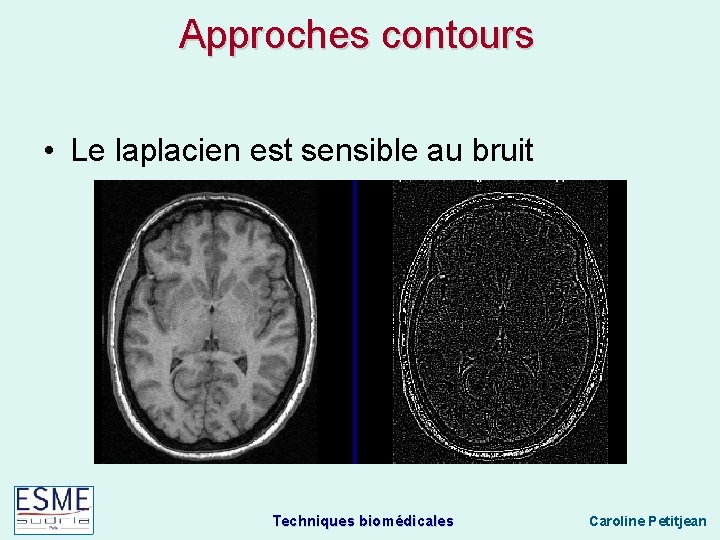 Approches contours • Le laplacien est sensible au bruit Techniques biomédicales Caroline Petitjean 