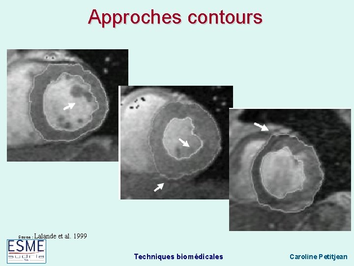 Approches contours Source : Lalande et al. 1999 Techniques biomédicales Caroline Petitjean 