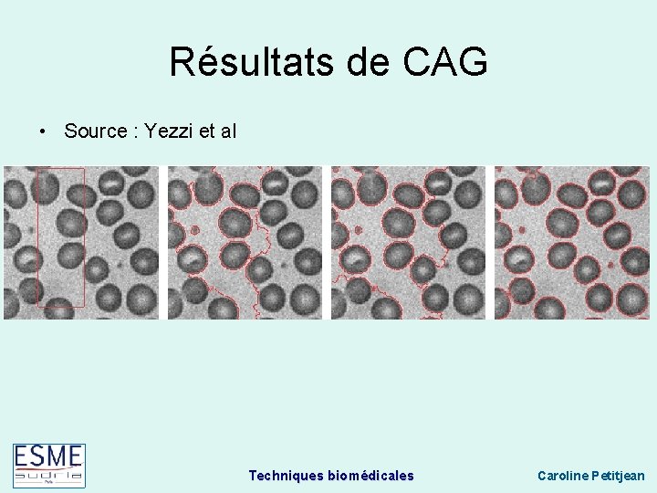 Résultats de CAG • Source : Yezzi et al Techniques biomédicales Caroline Petitjean 