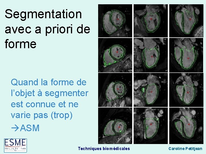 Segmentation avec a priori de forme Quand la forme de l’objet à segmenter est