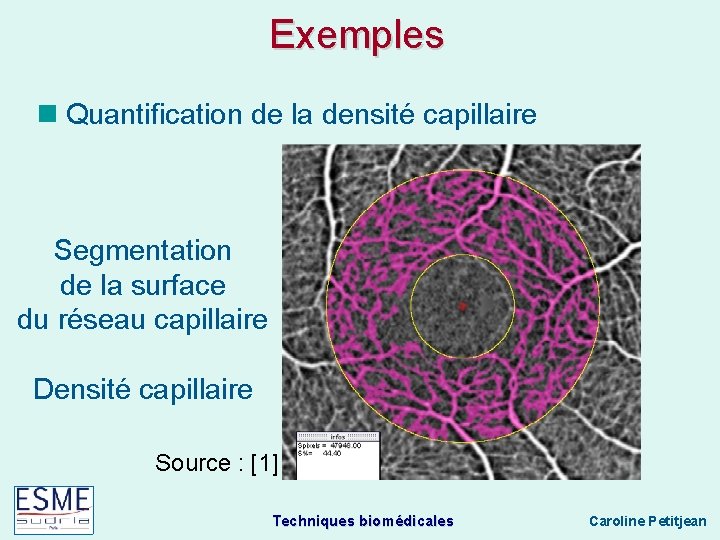 Exemples Quantification de la densité capillaire Segmentation de la surface du réseau capillaire Densité