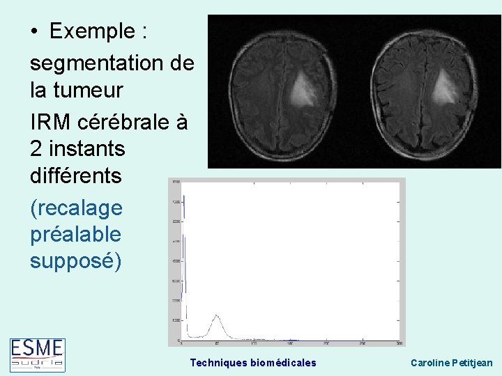  • Exemple : segmentation de la tumeur IRM cérébrale à 2 instants différents