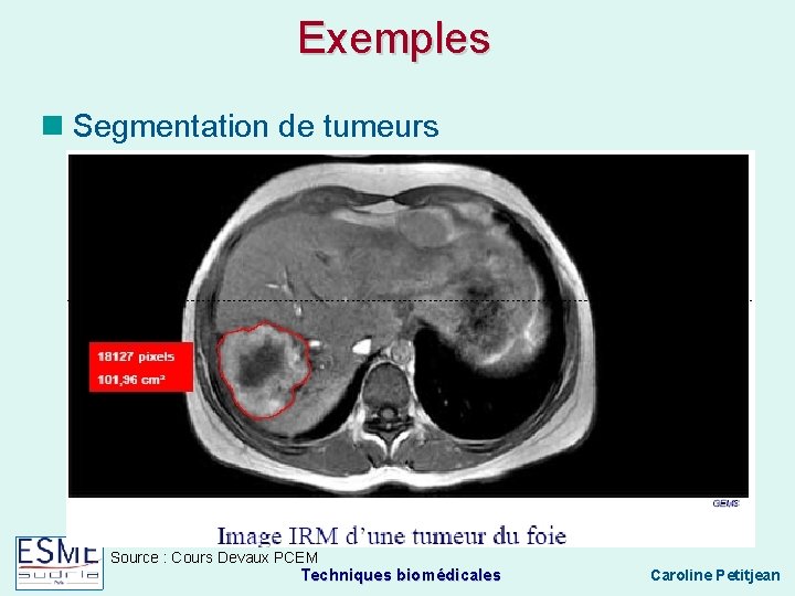 Exemples Segmentation de tumeurs Source : Cours Devaux PCEM Techniques biomédicales Caroline Petitjean 
