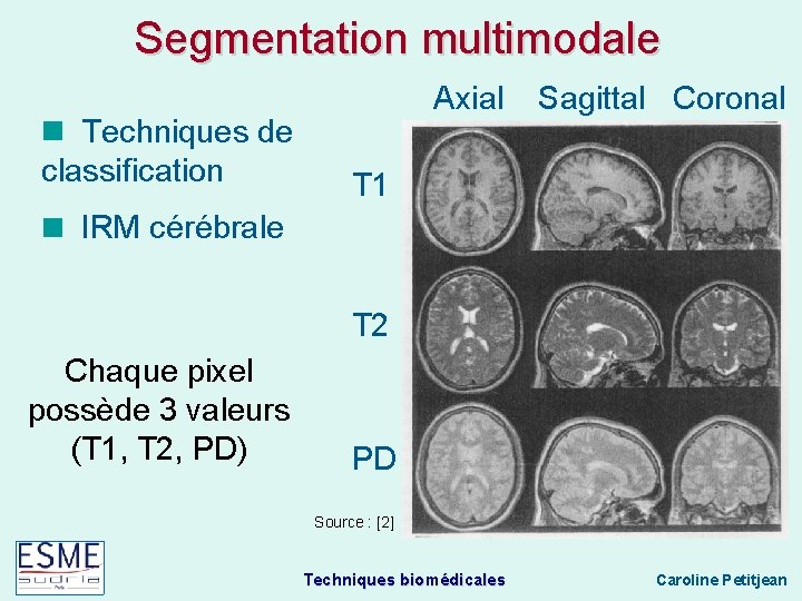 Segmentation multimodale Techniques de classification Axial Sagittal Coronal Techniques biomédicales Caroline Petitjean T 1