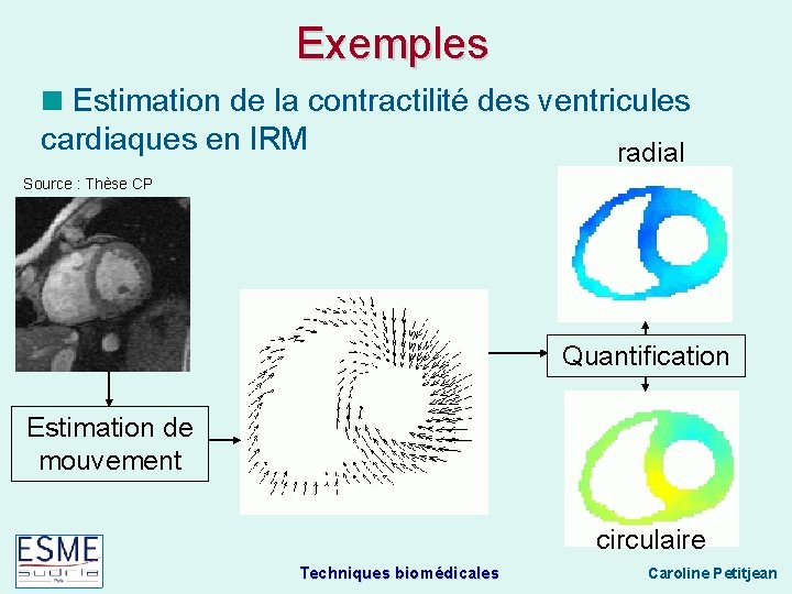 Exemples Estimation de la contractilité des ventricules cardiaques en IRM radial Source : Thèse