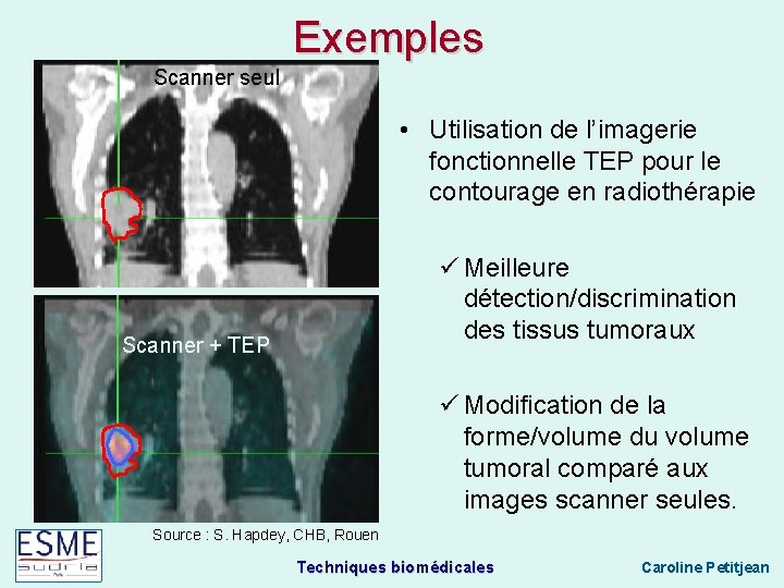 Exemples Scanner seul • Utilisation de l’imagerie fonctionnelle TEP pour le contourage en radiothérapie