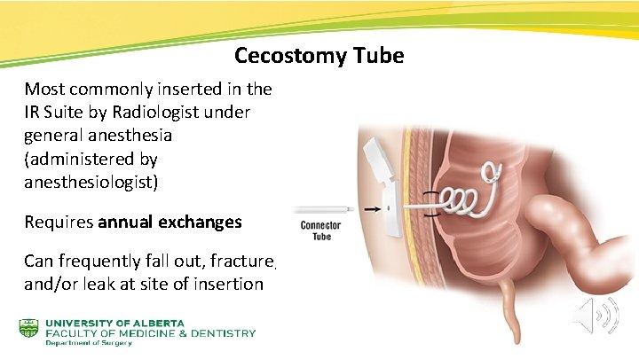 Cecostomy Tube Most commonly inserted in the IR Suite by Radiologist under general anesthesia