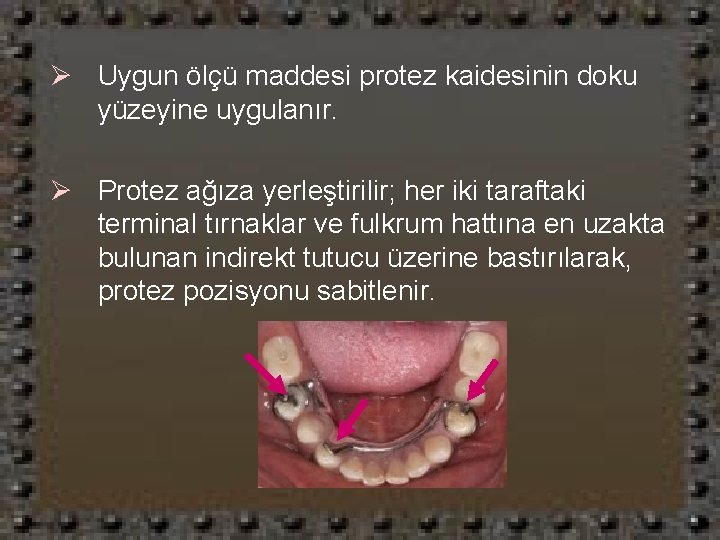 Ø Uygun ölçü maddesi protez kaidesinin doku yüzeyine uygulanır. Ø Protez ağıza yerleştirilir; her