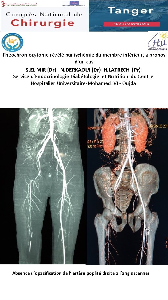 Phéochromocytome révélé par ischémie du membre inférieur, a propos d’un cas S. EL MIR