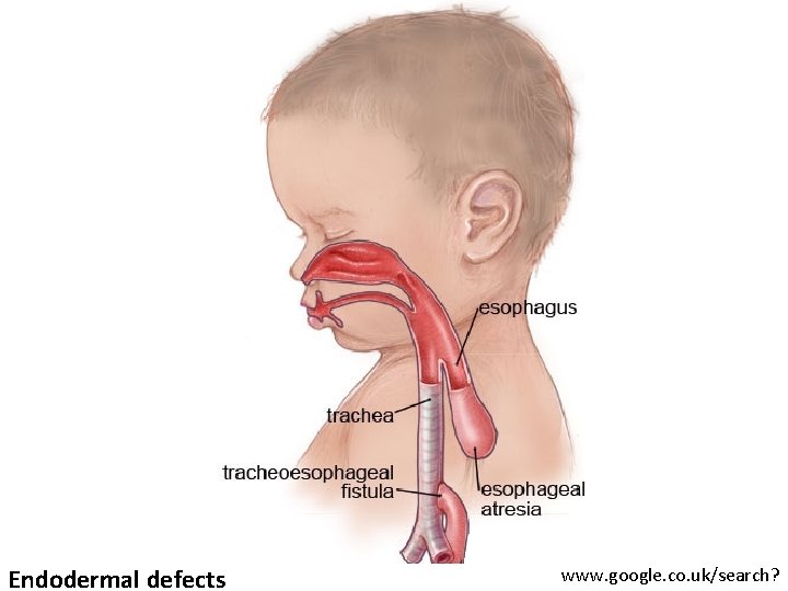 Endodermal defects www. google. co. uk/search? 