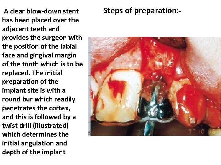 A clear blow-down stent has been placed over the adjacent teeth and provides the