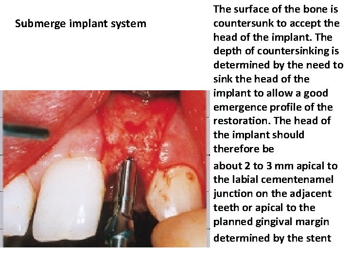 Submerge implant system The surface of the bone is countersunk to accept the head