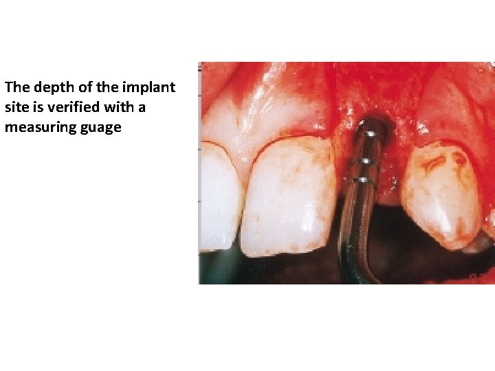 The depth of the implant site is verified with a measuring guage 