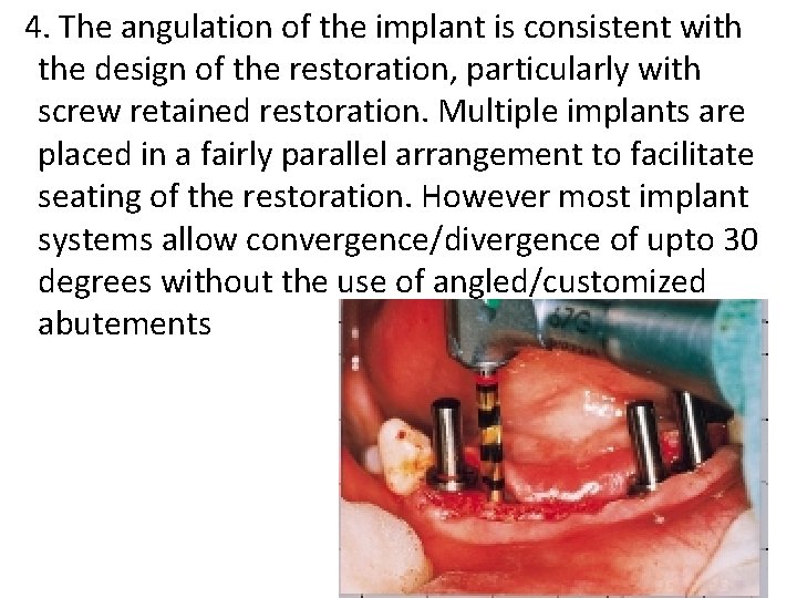 4. The angulation of the implant is consistent with the design of the restoration,