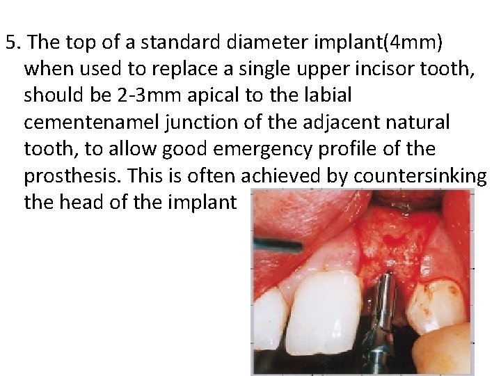 5. The top of a standard diameter implant(4 mm) when used to replace a