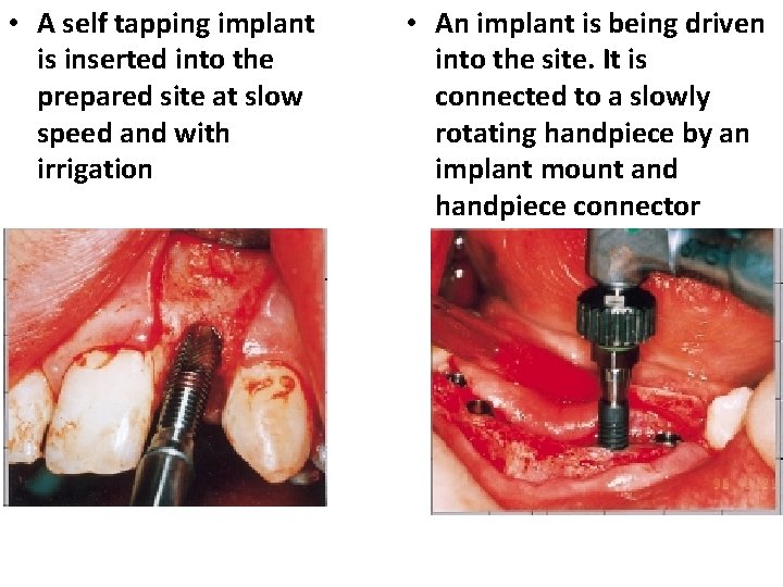  • A self tapping implant is inserted into the prepared site at slow