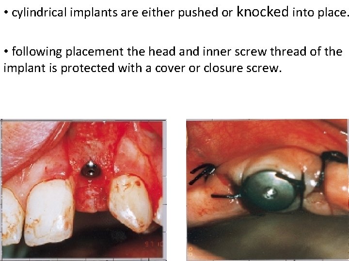  • cylindrical implants are either pushed or knocked into place. • following placement