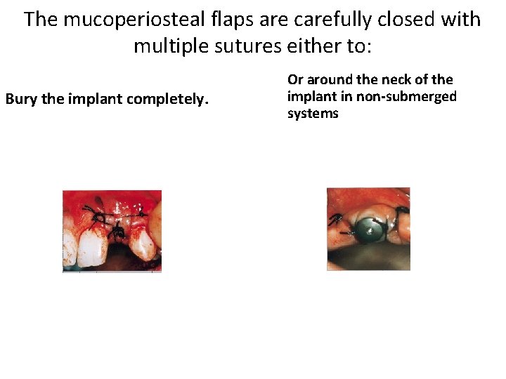 The mucoperiosteal flaps are carefully closed with multiple sutures either to: Bury the implant