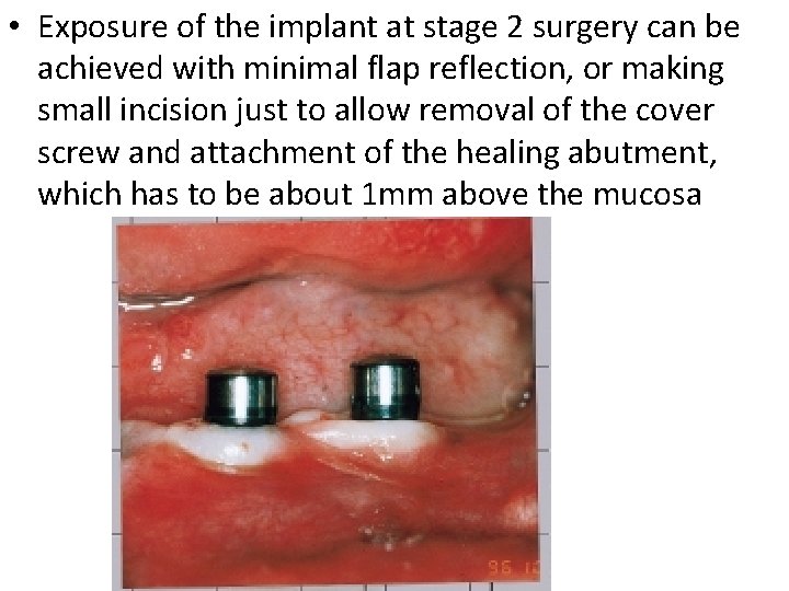  • Exposure of the implant at stage 2 surgery can be achieved with