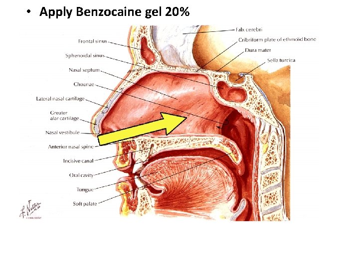  • Apply Benzocaine gel 20% 