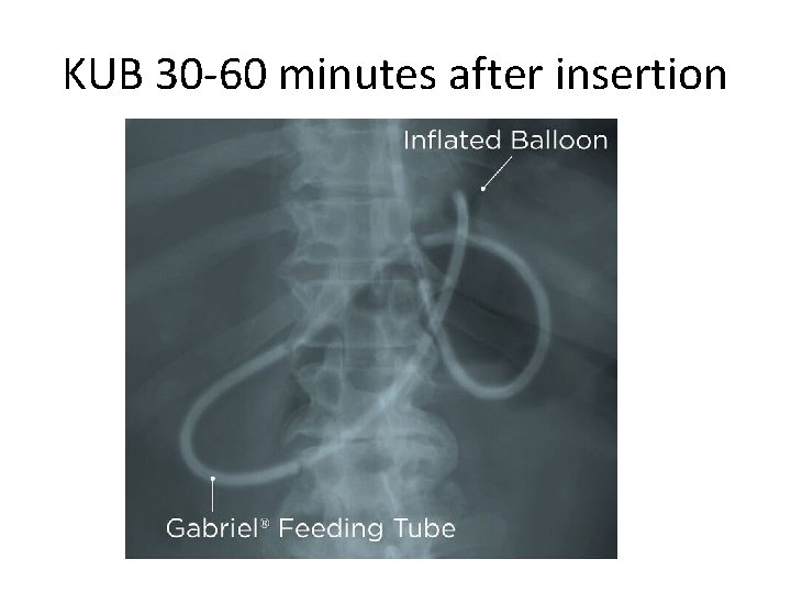 KUB 30 -60 minutes after insertion 